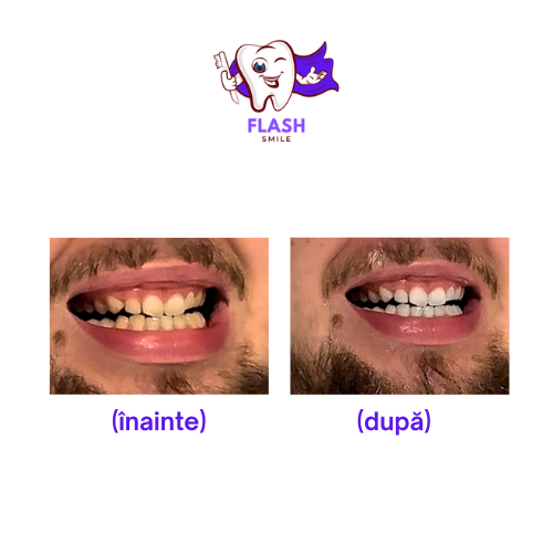 Corector V34-Flash Smile